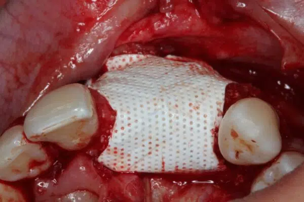 Guided Bone Regeneration Online Master Class | Jovanovic