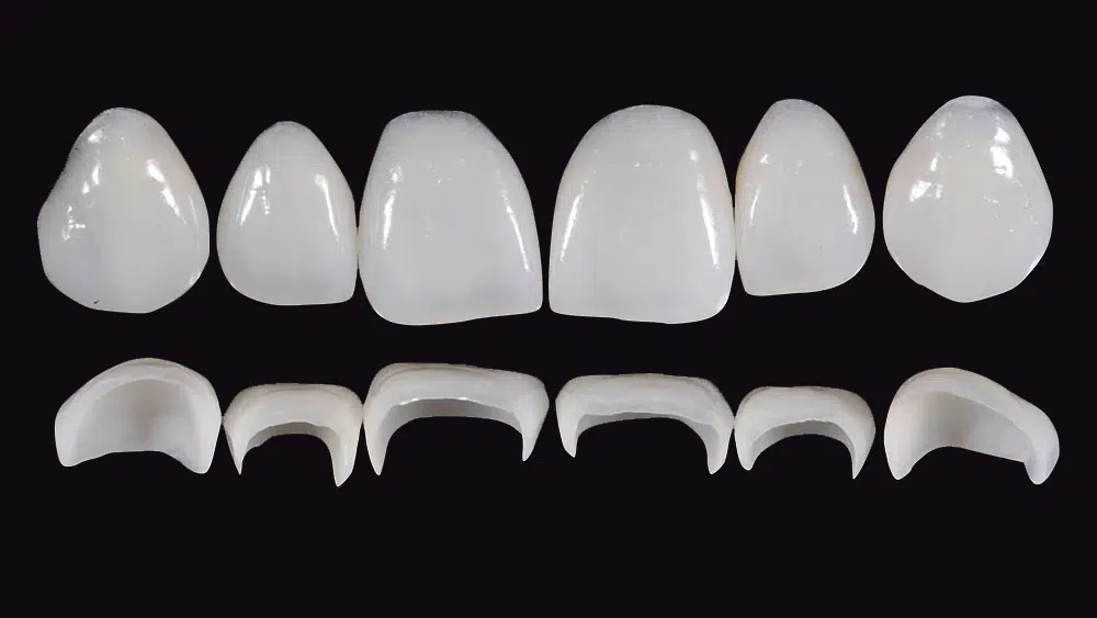 Prosthetic Rehabilitation on Natural Teeth – Predictable, Esthetic and Systematic Steps