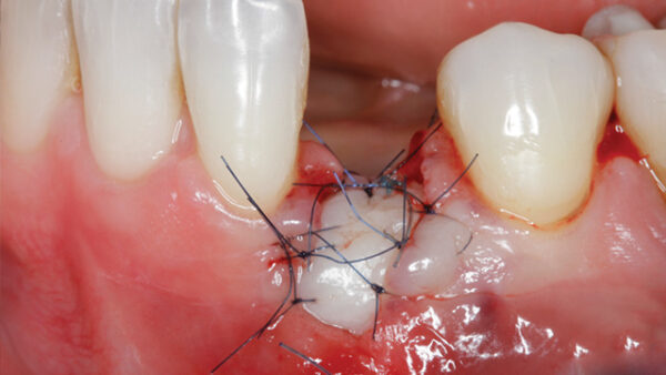 Soft Tissue Management around Natural Teeth and Dental Implants Online Master Class | Jovanovic