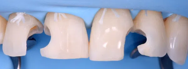 Direct and Indirect Adhesive Restorations Online Master Class | Ammannato