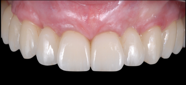 Full Arch Implant Solutions – From Diagnostic, Surgical to Restorative