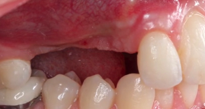 CLINICAL VIDEO Vertical and Horizontal GBR in the Anterior Maxilla using an Auto/Xenograft Mixture, PDGF Growth Factor, and d-PTFE Membrane