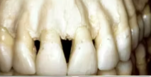 Alveolar Ridge Preservation for Implant and Pontic Site Development