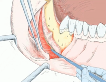 GBR Series (Part 3 of 4) - Surgical Predictability