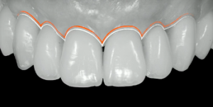 Hard & Soft Tissue Augmentation using GBR for Optimal Implant Esthetic & Long Term Success