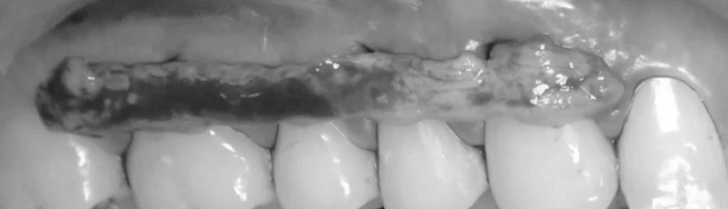 Tunneling & Mucogingival Therapy for Soft Tissue Management & Esthetics in 8 Videos | Kahn, Jovanovic, Madison, Mintrone