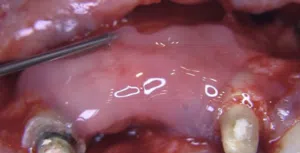 Emdogain application in conjunction with Implant placement and simultaneous GBR Augmentation