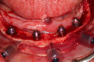 Full Arch Immediate Implant Treatment with 4 BLX Straumann Implants with 3D Printed Hybrid Prostheses in a Failed Lower Dentition Case