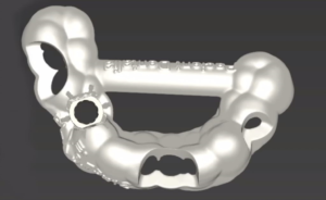 How to make a surgical guide in CDX and provisionals in Cares