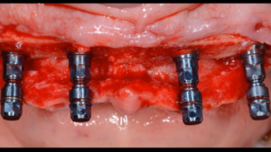 Implant-Retained Dentures - Evidence, Planning, and Execution