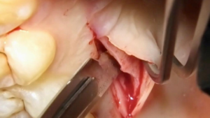 Palatal Connective Tissue Harvest for  Anterior Maxillary Immediate Tooth Replacement with BLT tapered implant