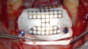 Vertical and Horizontal GBR Ridge Augmentation of a Severe Lower Anterior Bone Defect