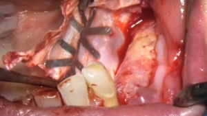 Vertical Ridge Augmentation in the Posterior Mandible - Membrane Removal and Implant Placement after 9 Months