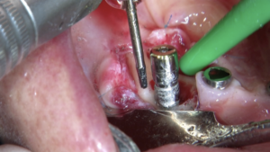 Surgical treatment of Periimplantitis with Implantoplasty