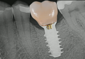 Replacing a Mandibular First Molar Using a Tissue Level Implant