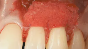 Contemporary, Minimally Invasive, Patient Oriented Approaches for the Treatment of Gingival Recessions
