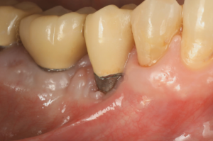 Soft Tissue Management around Implant Sites