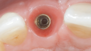 Single Tooth Replacement Revisited