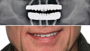 Predictable Immediacy - Surgical Steps for Optimal Full-Arch Immediate Loading